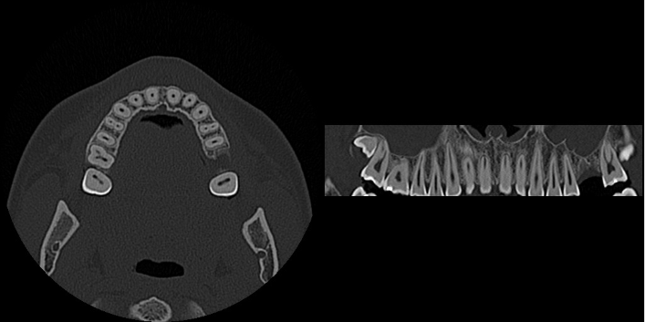 CT Aufnahme eines Gebisses