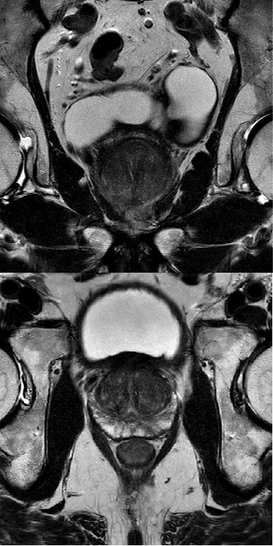 Prostatitis és medve Krónikus prosztatagyulladás tökolaj