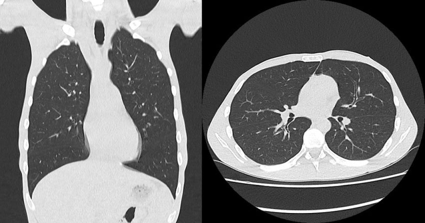 Befundbild eines Lungen CTs